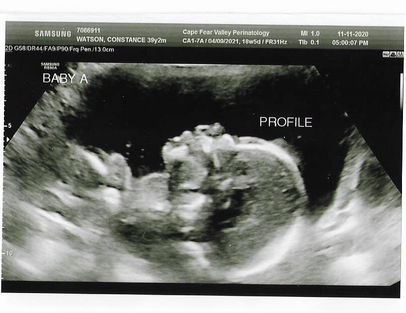 Jordan's ultrasound