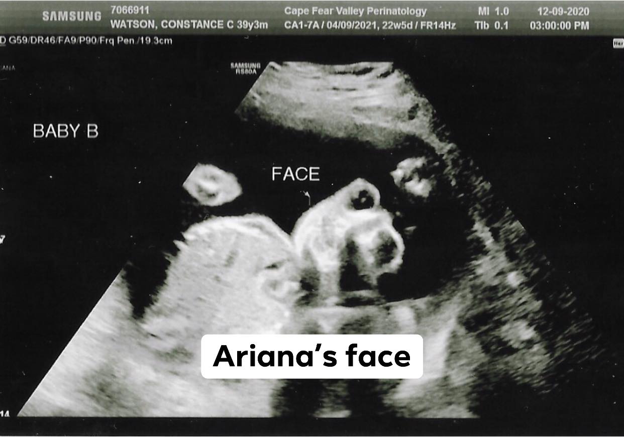 Ariana's ultrasound