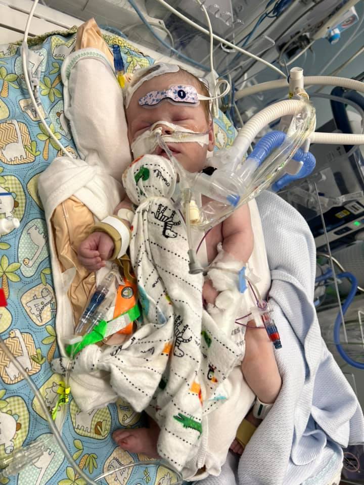 Norwood Procedure (2 weeks old)