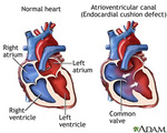 Luke's Heart Defect Compared to a 'Normal' Heart
