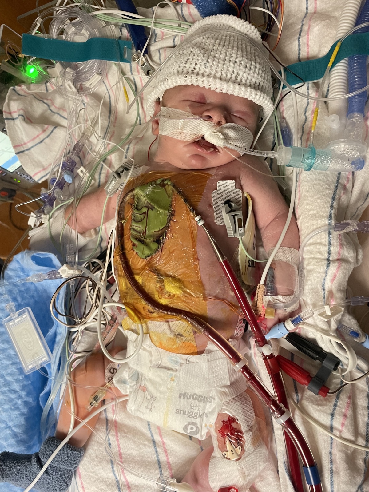 2nd time ECMO