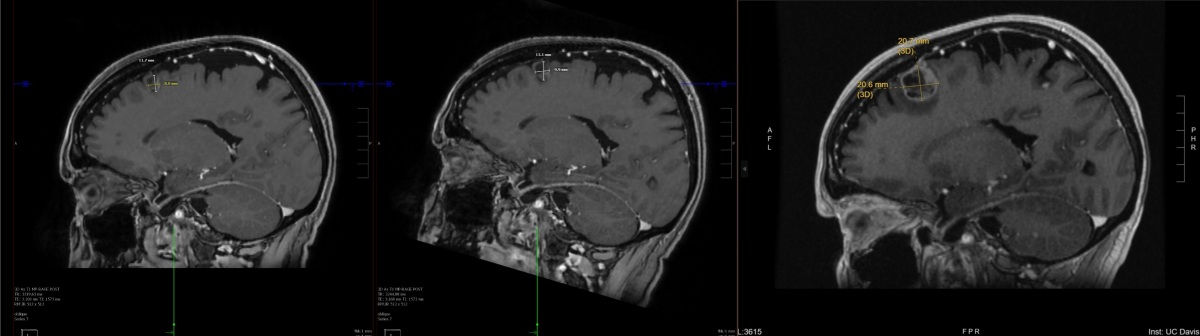 Progress brain scans - Left Lobe