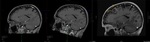 Progress brain scans - Left Lobe