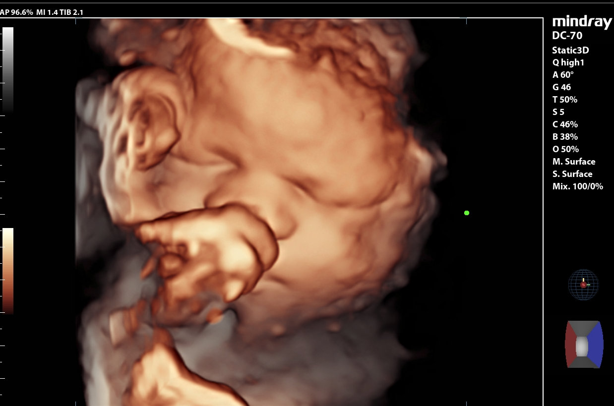Ultrasound Image