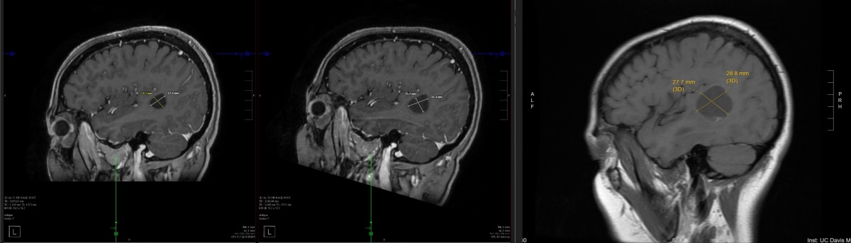 Progress Brain Scans - Right Lobe