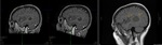 Progress Brain Scans - Right Lobe