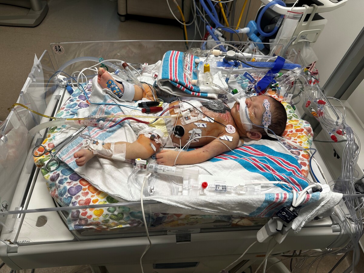Post-open heart surgery (Feb 2025)